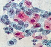 Schwere Zellveränderung Grad IV a (Karzinom)